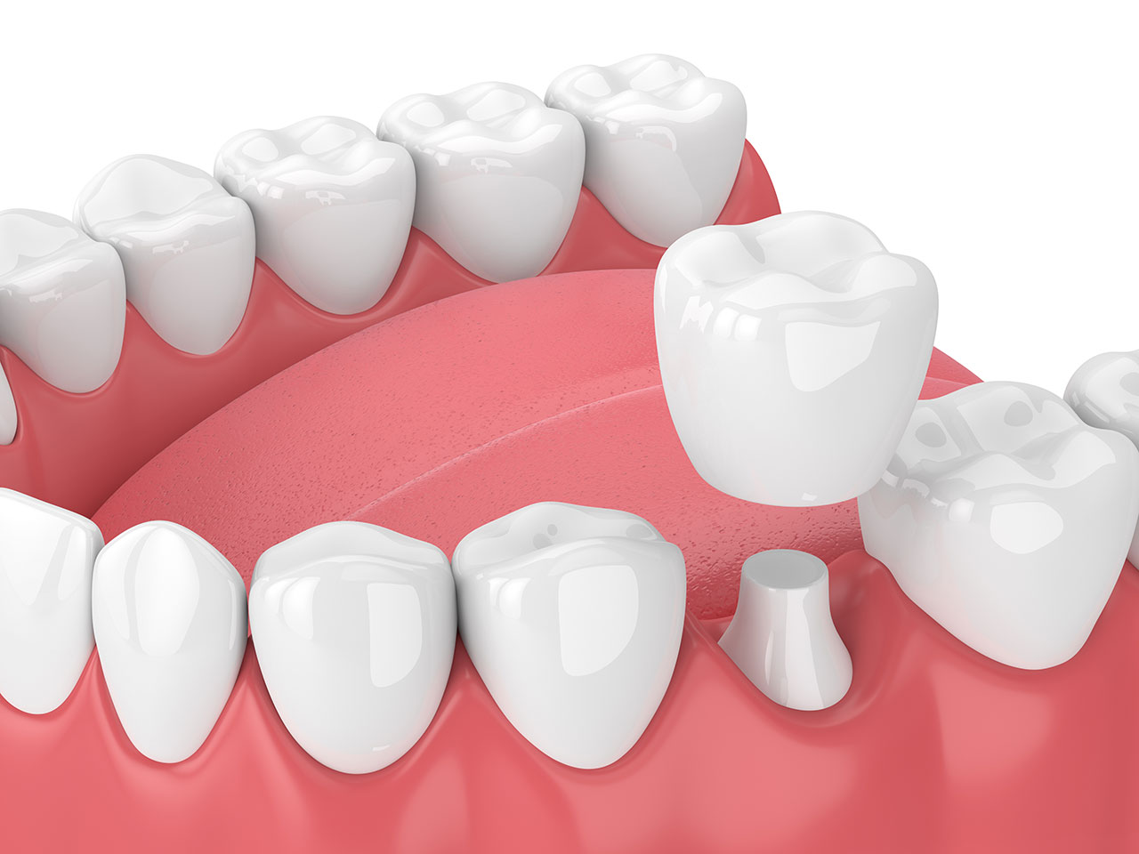 Can You Get a Dental Crown in One Day? A Guide to CEREC Same-Day Crowns